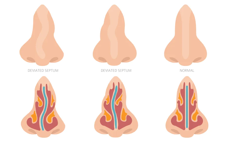 鼻中隔偏曲.png